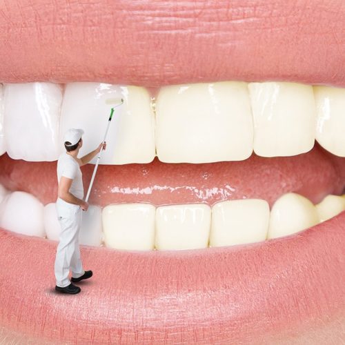 Diş Beyazlatma (Bleaching)